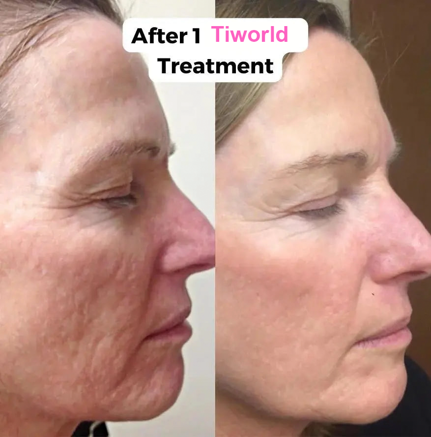 Tiworld™ Micro-Needling Infusion System💚《Free gift facial massager》